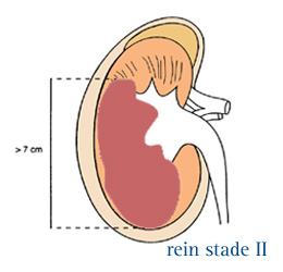 Infocancer Arcagy Gineco Localisations Rein Et Voies Urinaires