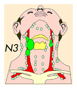 Cancers du larynx (cancers de la gorge)
