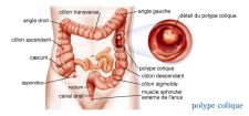 Cancer du côlon & du rectum
