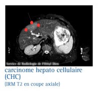 Cancers du foie (hépatocarcinome)