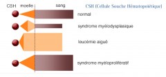 Les syndromes myélodysplasiques (SMD)